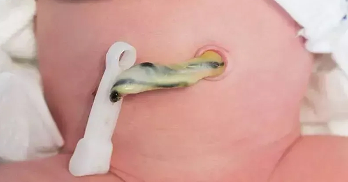 Umbilical Cord