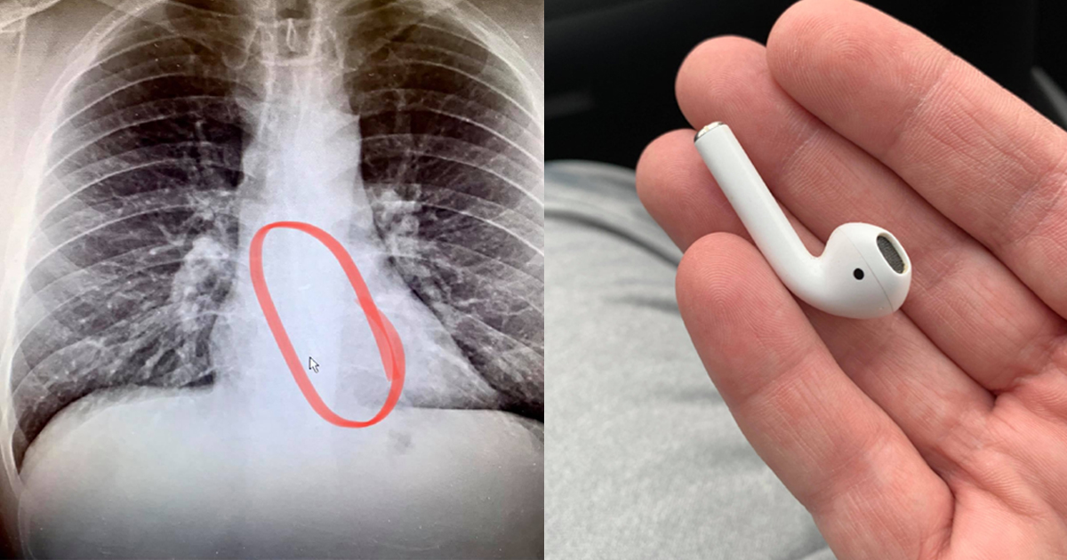 Man Swallows An AirPod