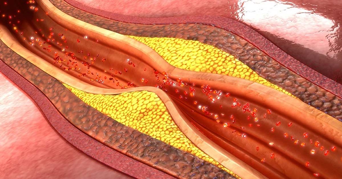 Atherosclerosis