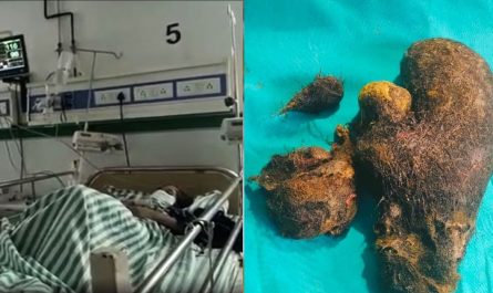 Two and a half kilos of hair was removed from the girls stomach