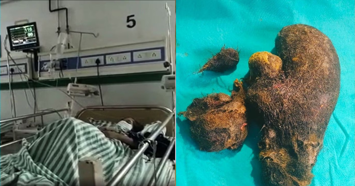 Two and a half kilos of hair was removed from the girls stomach