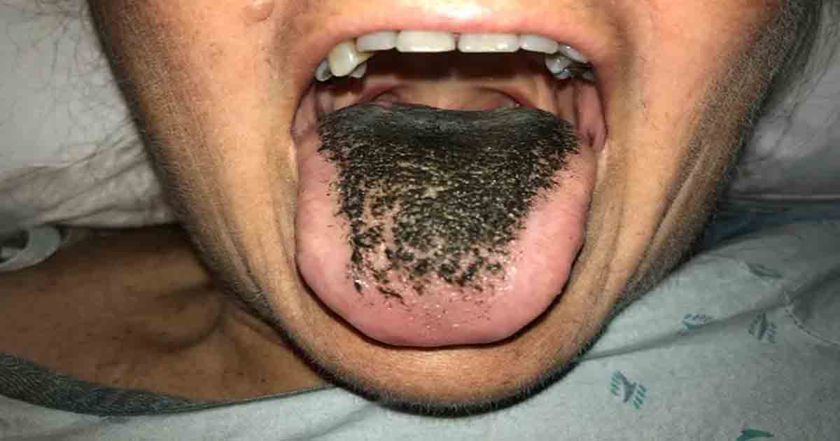 A girl with a strange condition where hair grows on her tongue