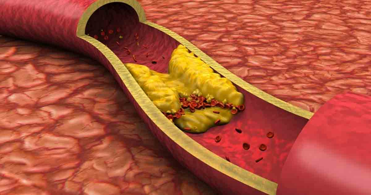 Cholesterol